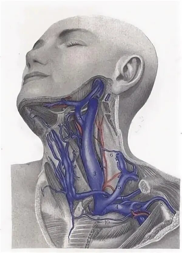 Внутренняя яремная Вена справа. Расширение яремной вены