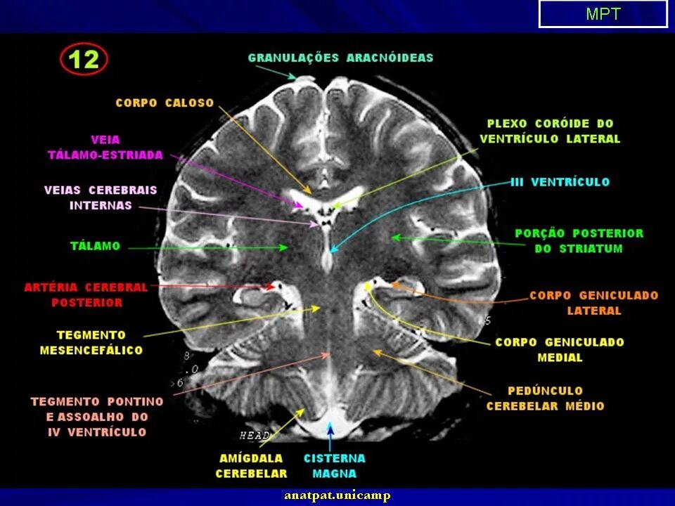 Усиленный в базальных отделах. Базальные ядра мозга мрт. Мрт головного мозга аксиальный срез. Средний мозг мрт норма. Анатомия мозолистого тела головного мозга мрт.