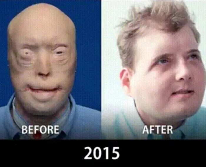Пересадка лица до и после фото - SadPhoto.ru