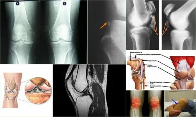 Лигаментита связок коленного. Лигаментоз коленного сустава рентген. Лигаментоз надколенника. Оссифицирующий лигаментоз коленного сустава.