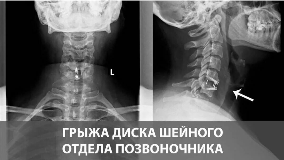 Грыжи шейного отдела позвоночника лечение без операции. Грыжа диска с6 с7 шейного отдела позвоночника рентген. Диск с5-6 шейного отдела. Грыжа межпозвонкового диска с5-с6. Грыжа диска с5 с6.