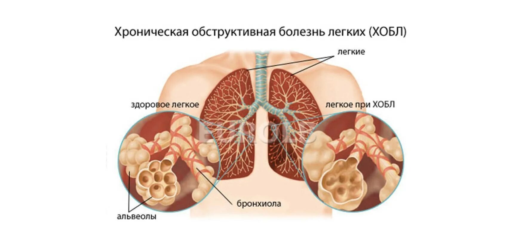 Хобл. Хобл хроническая обструктивная болезнь. хроническая обструктивная болезнь легких. хроническая обструктивная легочная болезнь. хронические обструктивные заболевания лёгких.