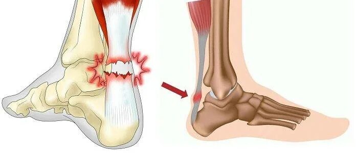 Разрыв ахиллова сухожилия голеностопного сустава. Растяжение ахиллова сухожилия. Разрыв связок ахиллова сухожилия. Ахиллесово сухожилие разрыв.