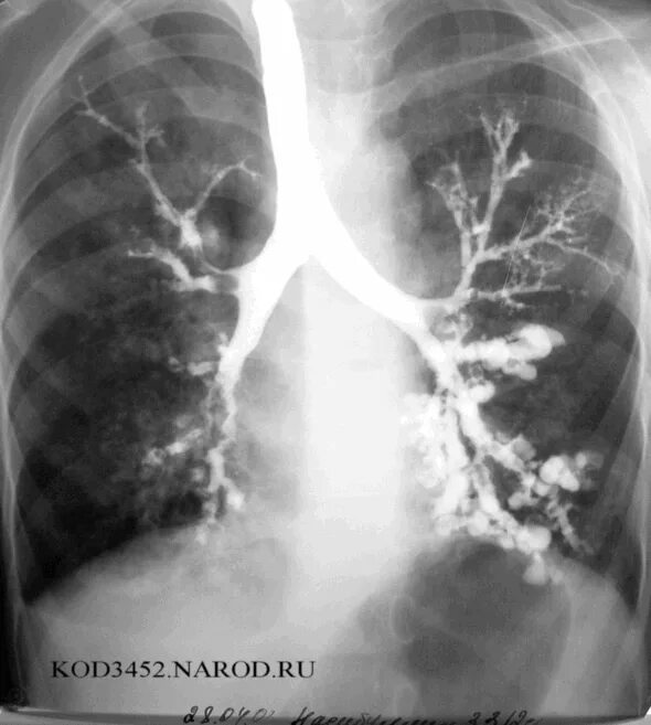 Бронхоэктазы рентген бронхография. Бронхоэктатическая болезнь легкого рентген. Бронхография цилиндрические бронхоэктазы. Бронхоэктазы в легких на рентгене. Заболевание легких на первых