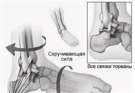 Повреждение голеностопного сустава мкб 10