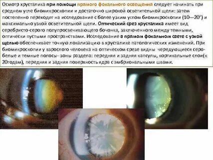 После замены хрусталиков сколько времени