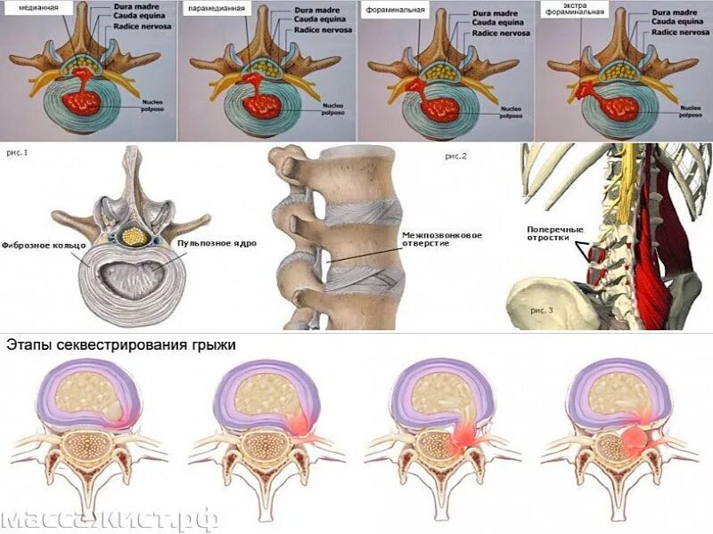 Диффузное выбухание межпозвоночного. Парамедианная грыжа диска l4-l5. Фораминальная экструзия диска l4-l5. Медианно-парамедианная протрузия диска. Классификация грыж поясничного отдела позвоночника.