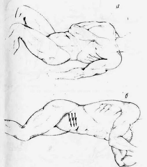 Симптом ситковского острого аппендицита. Симптоматика при аппендиците. Симптом ровзинга при аппендиците. Признак щеткина-блюмберга. Симптом бартомье михельсона.