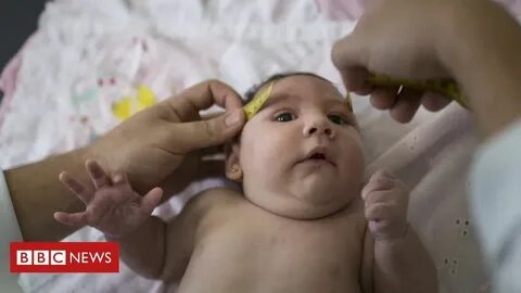 Симптомы микроцефалии у детей