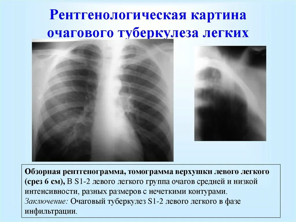 Туберкулез легкого рентгенограмма. Инфильтративный туберкулез легких с1 с2 с 6. Очаговый туберкулез рентген. Очаговый туберкулез симптомы рентген. Инфильтративный туберкулез рентгенодиагностика.