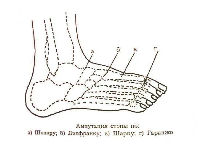 Удаление стопы ноги. Ампутация по Шопару схема. Ампутация стопы по Шопару. Уровни ампутации стопы по шарпу. Ампутация стопы по шарпу.