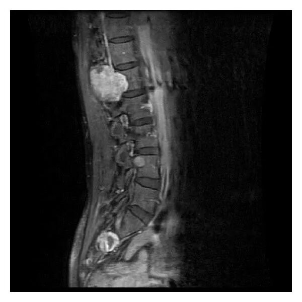 Рак поясницы. Невринома поясничного отдела позвоночника мрт. Гигантоклеточная опухоль позвоночника мрт. Липома поясничного отдела позвоночника мрт. Хондрома позвоночника.