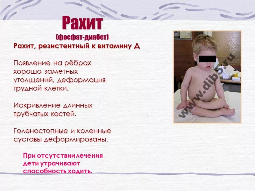 Рахит 6 лет. Гипофосфатемический витамин-d-резистентный рахит. витамин д-резистентный рахит наследуется по…. фосфат-диабет (витамин д резистентный рахит). витамин д резистентный рахит.