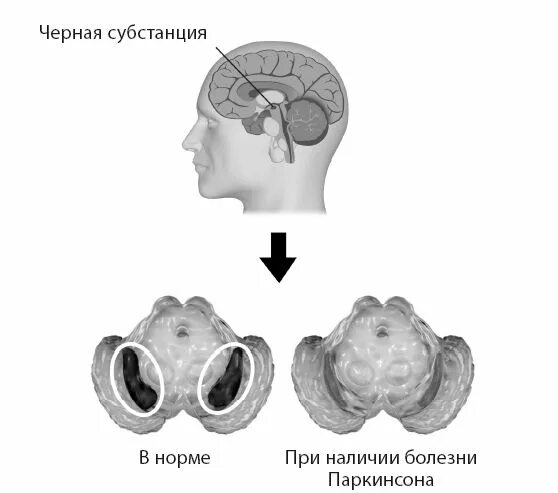 Нестареющий мозг. Болезнь паркинсона черная субстанция. черная субстанция при болезни паркинсона. нестареющий мозг бредесен.