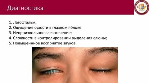 Лагофтальм