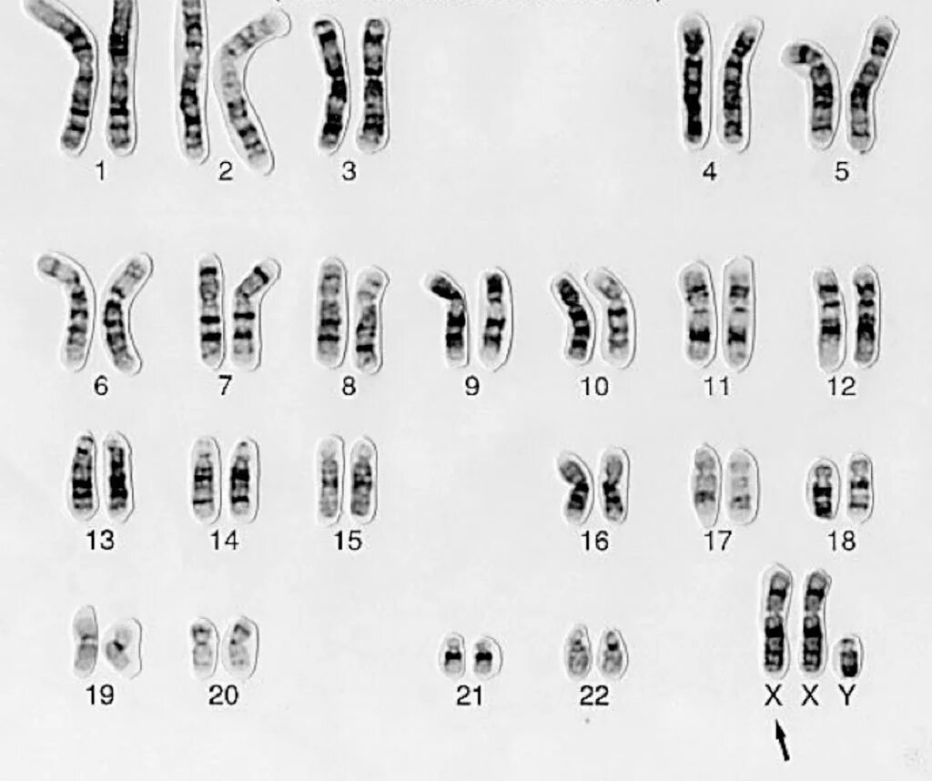 Сколько хромосом у кошки. Синдром Дауна трисомия 21 хромосомы. Трисомия 21 хромосомы (синдром Дауна кариотип. Хромосомная карта синдрома Шерешевского Тернера. Синдром Шерешевского Тернера кариотип.