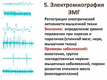 Электромиография принцип метода