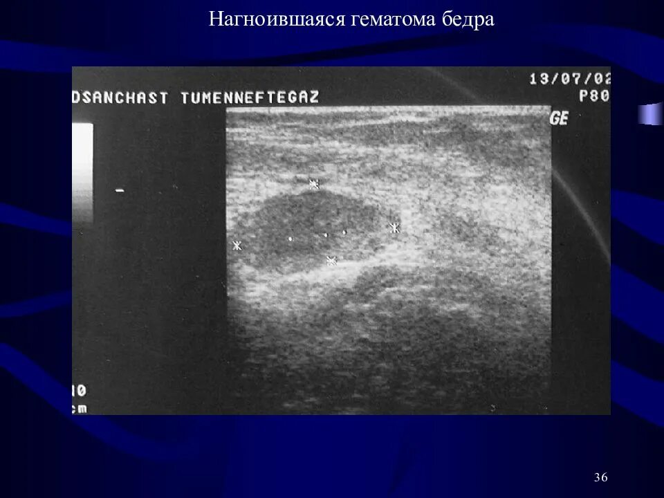 Забрюшинная гематома на УЗИ. Нагноившаяся гематома мягких тканей на УЗИ. Гематома мягких тканей на УЗИ. Гематома в стадии организации