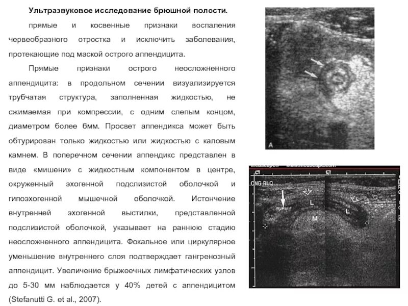 Ли узи. УЗИ при остром флегмонозном аппендиците. Флегмонозный аппендицит УЗИ протокол. УЗИ при остром флегмонозном аппендиците заключение. Острый аппендицит на УЗИ протокол.