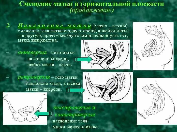 Ретродевиация матки что это такое