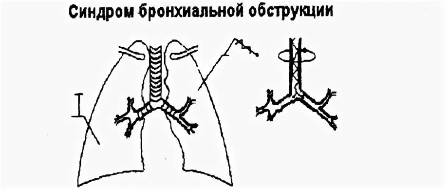 Синдром бронхиальной обструкции