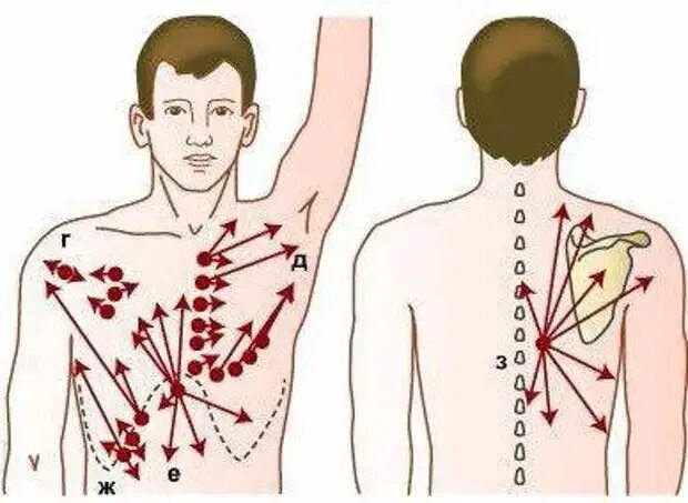 Локализация боли при остеохондрозе. Иррадиация боли при остеохондрозе. Локализация боли при грудном остеохондрозе. Болевые точки на грудной клетке. Иррадиация в левую лопатку