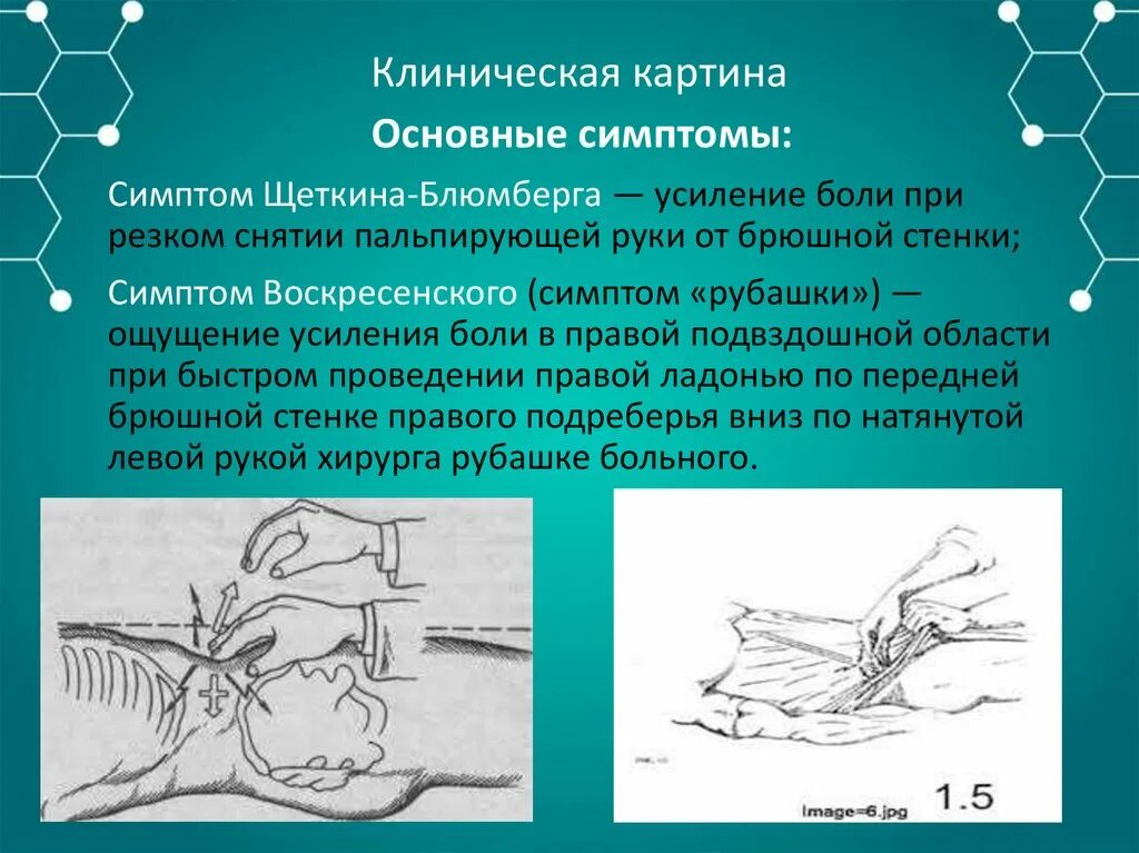 Аппендицит щеткина