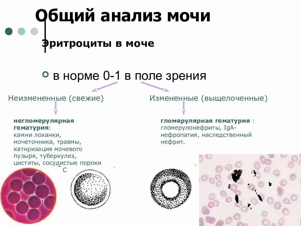 Измененные и неизмененные эритроциты в моче. Выщелоченные эритроциты в моче. Эритроциты в моче свежие и измененные. Свежие и выщелоченные эритроциты в моче. Эритроциты в моче у ребенка повышены причины