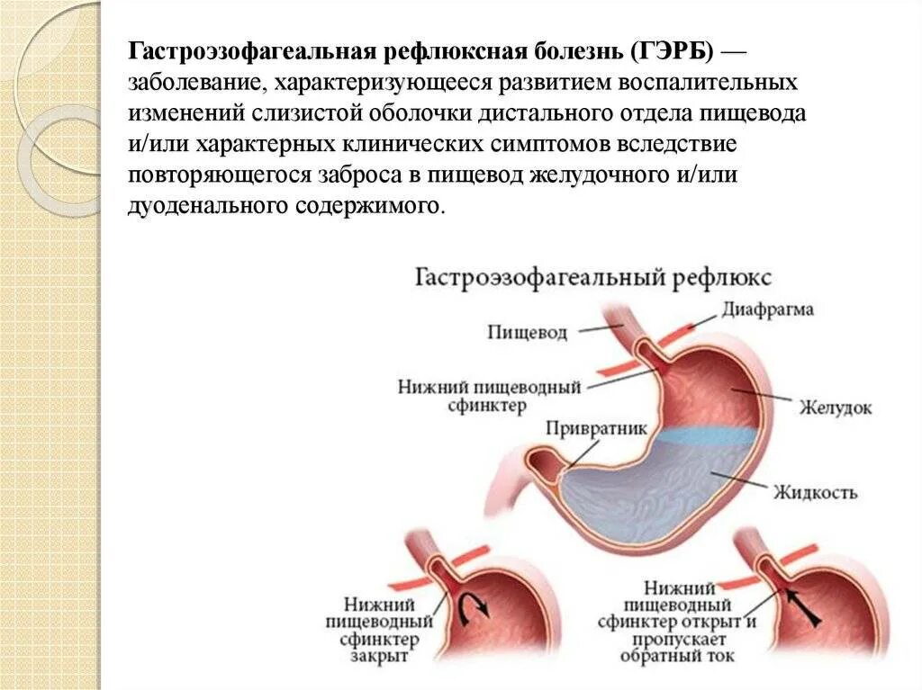 Гэрб с эзофагитом лечение. Гастроэзофагеальная-рефлюксная болезнь ФГДС. Рефлюксная болезнь желудка рефлюкс. Рефлюксная болезнь сфинктер. Симптомы гастроэзофагеальной рефлюксной болезни.