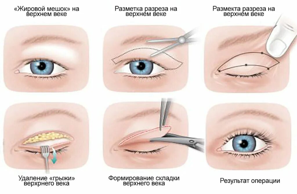 Почему отекают веки по утрам. Блефаропластика верхних век схема. Пластика нижних век (блефаропластика) (нижняя). Пинч блефаропластика нижних век. Блефаропластика нижних век схема операции.