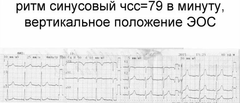 Синусовый ритм вертикальное эос. Заключение экг эос. заключение экг синусовый ритм вертикальное положение эос. эос вертикальная на экг что это. заключение экг вертикальная эос.