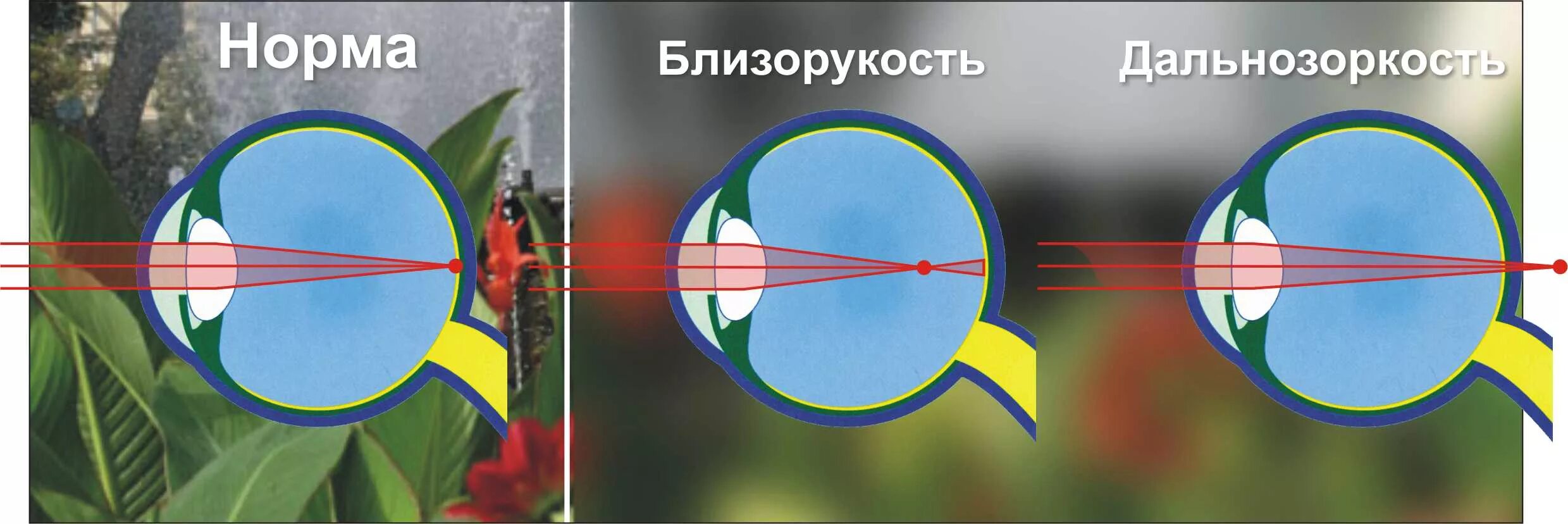 Фокусировка глаза человека. Глаз человека близорукость и дальнозоркость. Зрения астигматизм миопия. Зрение схема близорукость и дальнозоркость. Миопия схема глаза.