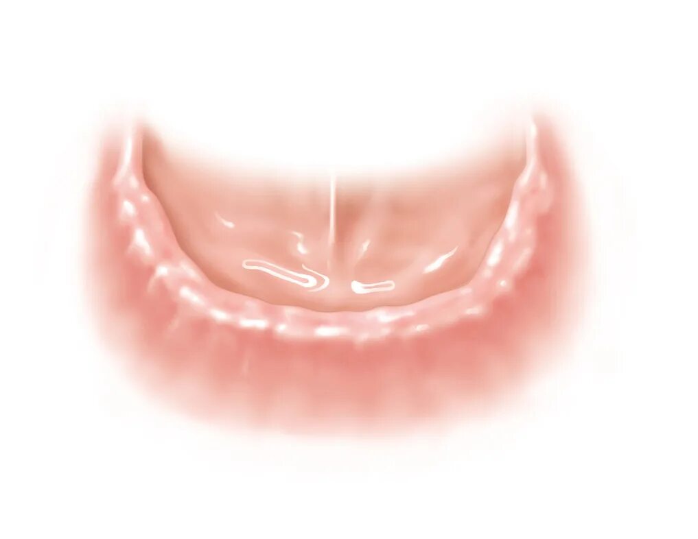 Переходная складка слизистой. Адентия нижней челюсти. Адентия верхней челюсти. Частичная адентия полости рта.