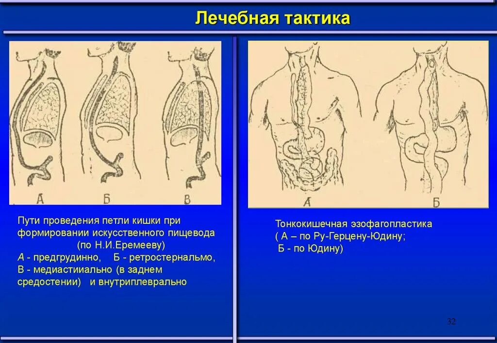 Загрудинная пластика пищевода по н.и. Еремееву. Операция пластики пищевода. Принципы пластики пищевода.