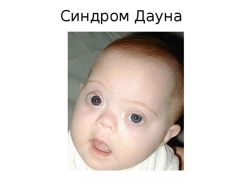 Как выявить синдром дауна. Синдром дауна. плоское лицо. новорожденный с синдромом дауна.