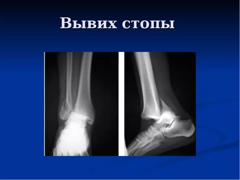 Вывих сустава стопы. Подвывих голеностопного сустава рентген. подвывих стопы кнаружи рентген.