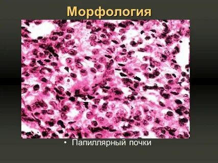 Папиллярный почечно клеточный