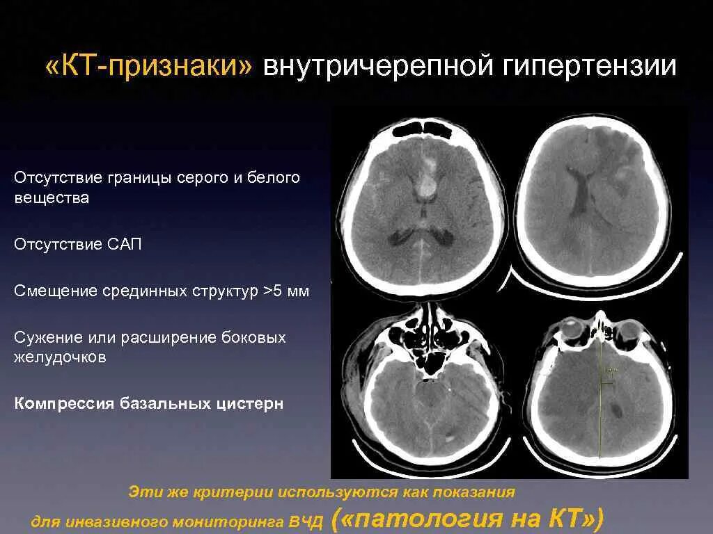 Причины сужения головного мозга. МСКТ внутричерепная гипертензия. Повышение внутричерепного давления мрт. Внутричерепная гипертензия нейросонография. Синдром внутричерепной гипертензии.