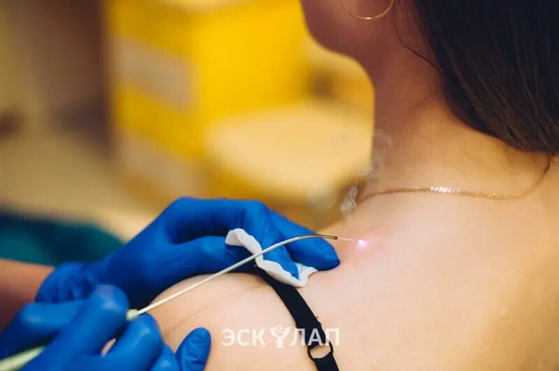 Как сделать в москве операцию по полису омс. Операция варикоза по омс. Лазерное удаление по омс. Лазерная операция на варикоз. Прижигание лазером папиллом.