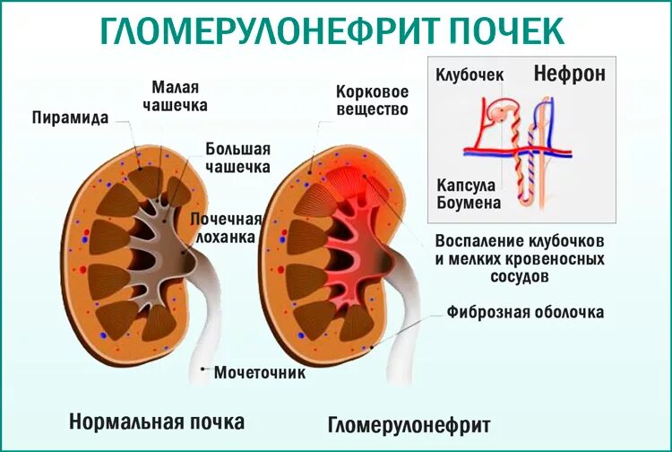 Гломерулонефрит воспаление клубочков почки. Острый гломерулонефрит patogenez. Поражение клубочков гломерулонефрит. Клубочек почки при гломерулонефрит. Поражение клубочков почек