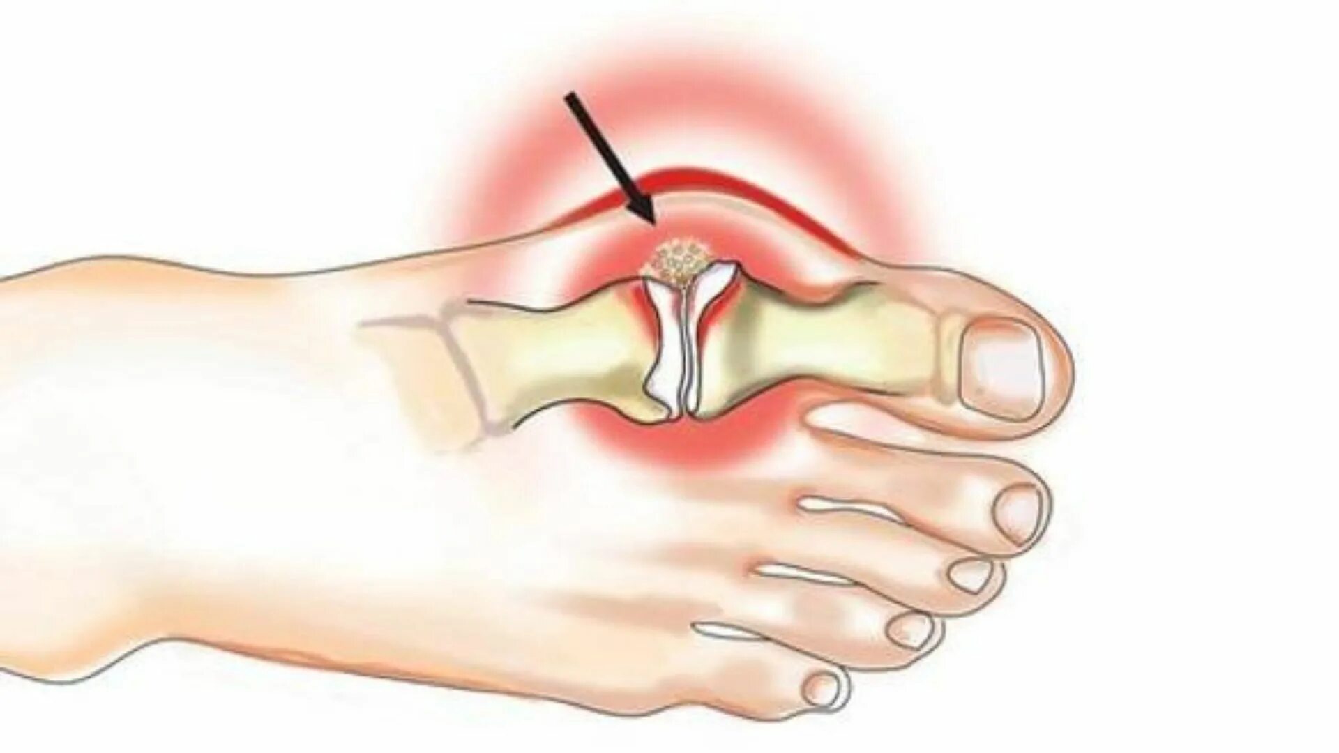 Почему болят суставы больших пальцев. Болит сустав большого пальца на ноге. Артрит сустава большого пальца стопы. Воспаление сустава большого пальца на ноге.