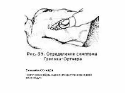 Симптом курвуазье