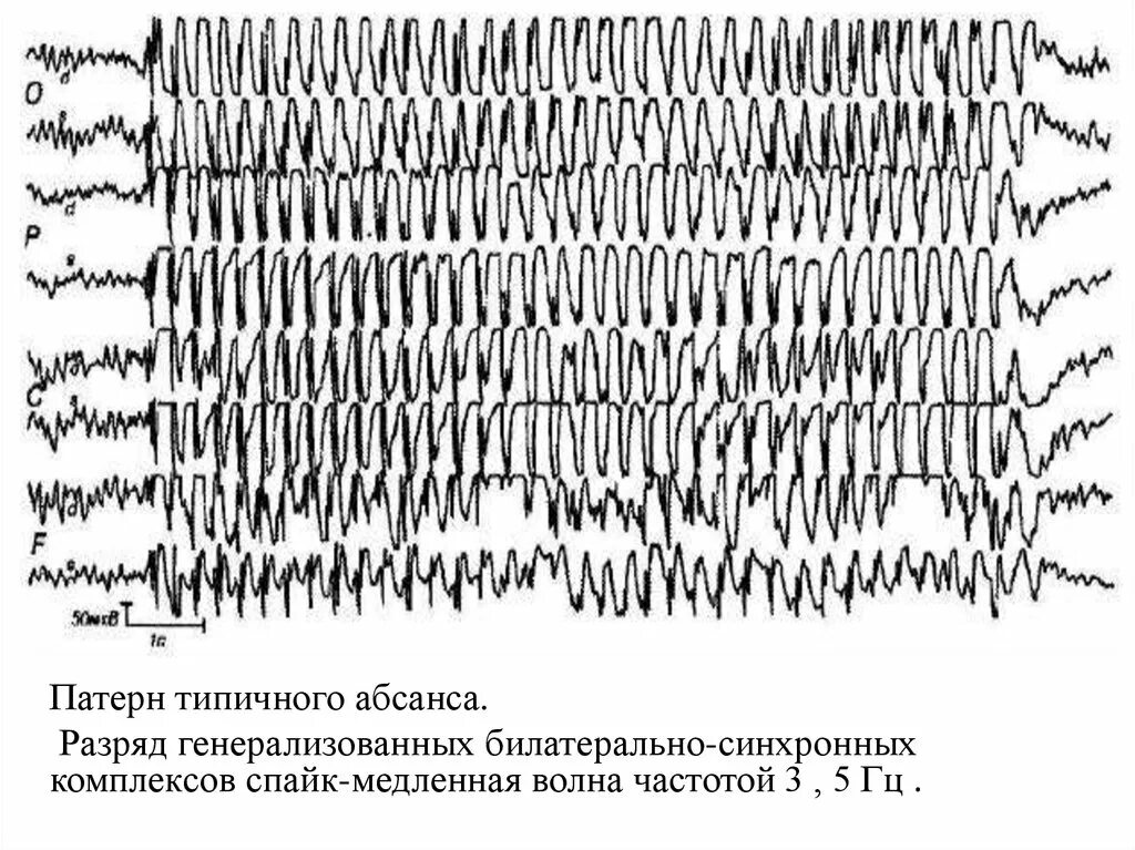 Билатерально синхронная. Билатерально синхронная. Билатерально синхронная. Вертексные волны на ээг. Билатеральное мышление.