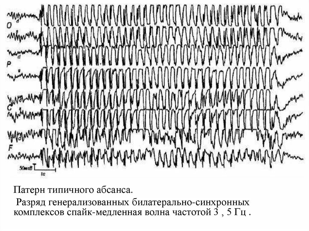 Медленные волны на ээг. Абсанс эпилепсия ЭЭГ. Генерализованные Спайк волновые разряды на ЭЭГ. Паттерн абсанса на ЭЭГ. Генерализованные формы эпилепсии абсансы ЭЭГ.