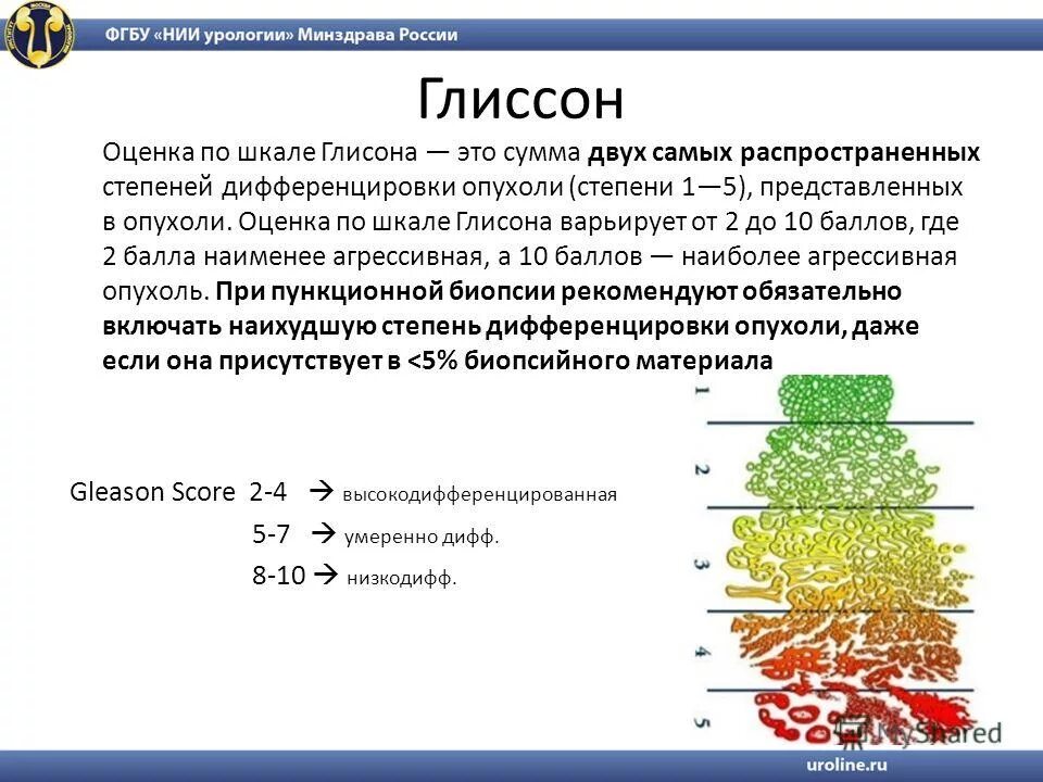 Глисон простата. Классификация Глисон предстательной железы. Гистологическая классификация опухолей предстательной железы. Шкала Глиссона. Оценка по глисону.