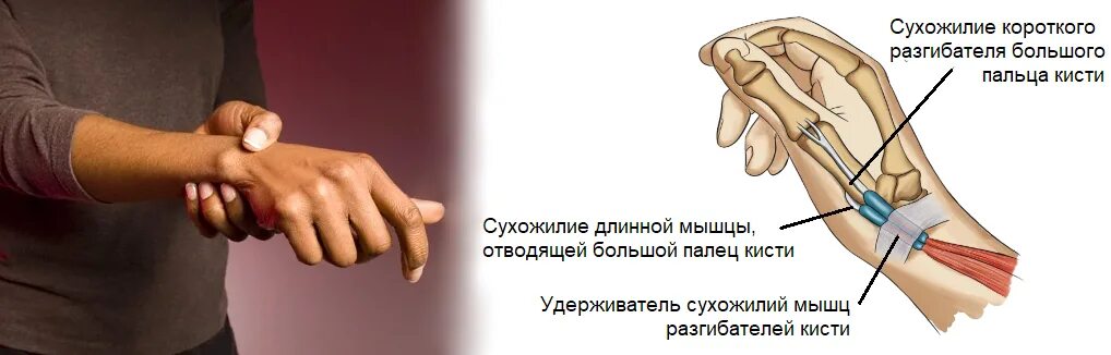 Почему утром болят руки. Болит кисть в лучезапястном суставе. Болит кисть и запястье правой руки.