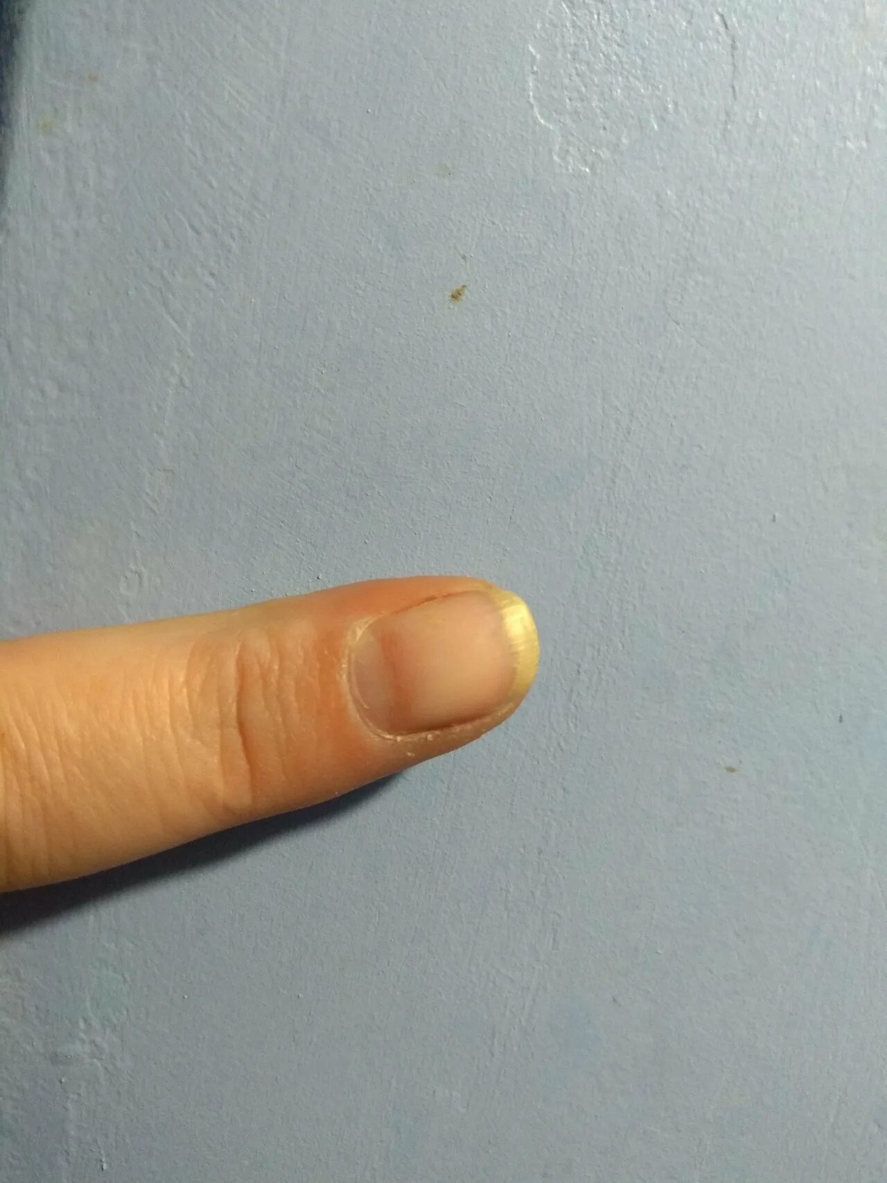 Пятно на ногте указательного пальца. Коричневая полоса на ногте. пятно на ногте на указательном пальце. коричневые полоски на ногтях. коричневая полоса на пальце.