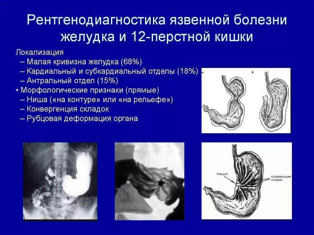 Стеноз кишечника что это. Язва малой кривизны желудка рентген. Язвенная болезнь 12 перстной кишки симптомы. Язвенная болезнь двенадцатиперстной кишки рентген. Пенетрирующая язва малой кривизны желудка рентген.