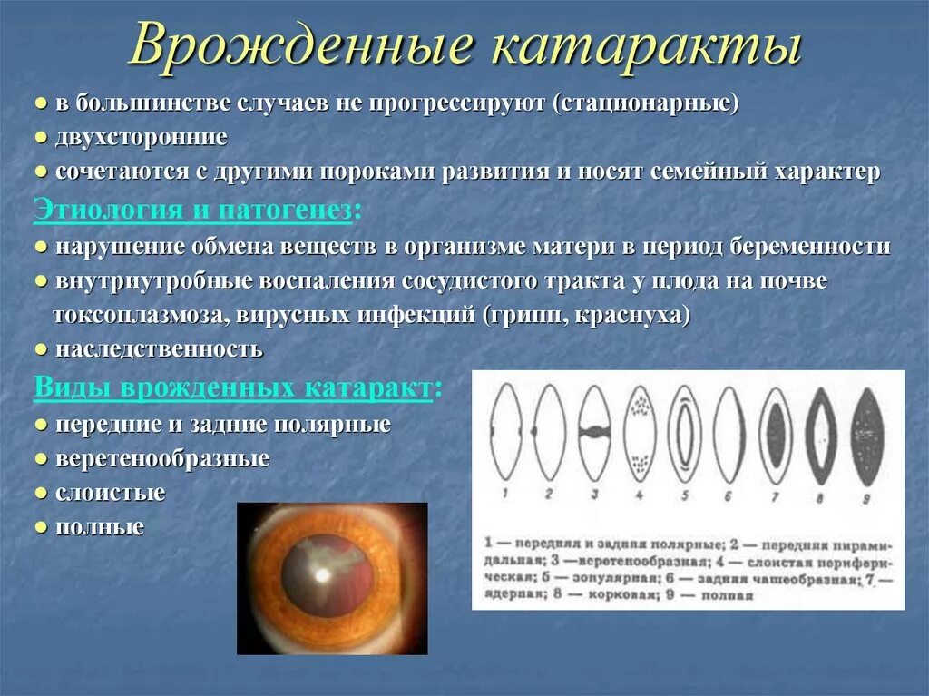 Передне капсулярная катаракта. Веретенообразная врожденная катаракта. Врожденные катаракты этиологические факторы. Кольцевидная катаракта Фоссиуса.