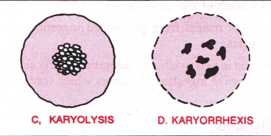 Кариопикноз это. Кариорексис кариолизис. Пикноз ядер нейтрофилов. Кариопикноз кариорексис кариолизис некроз. Пикноз ядра.